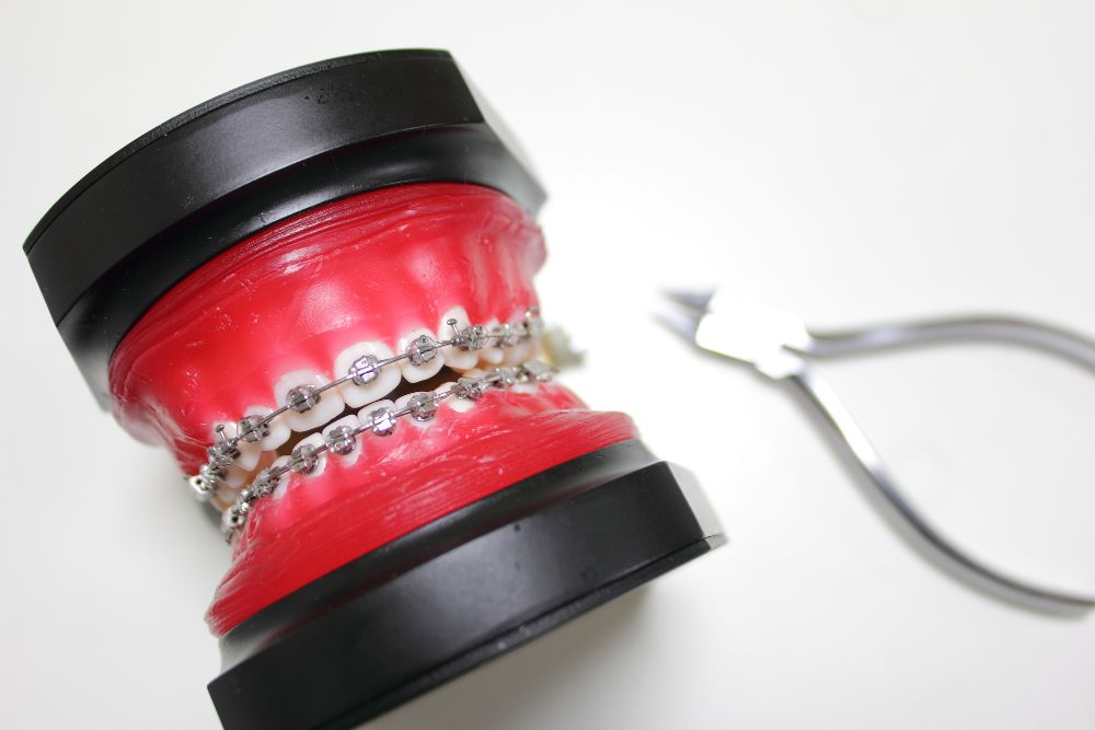 ワイヤー矯正をする歯の模型と治療器具